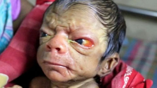 Bangladesh baby born looking like an old man