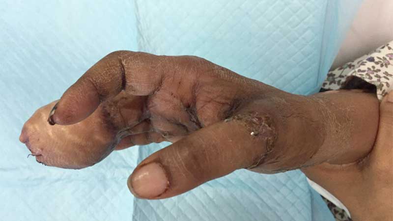 Woman's fingers severed in Diwali firecracker accident