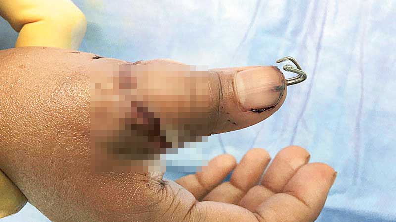 Dubai woman's thumb severed in 'tug of war'