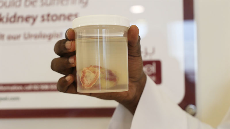 Rare tumour removed from Abu Dhabi woman