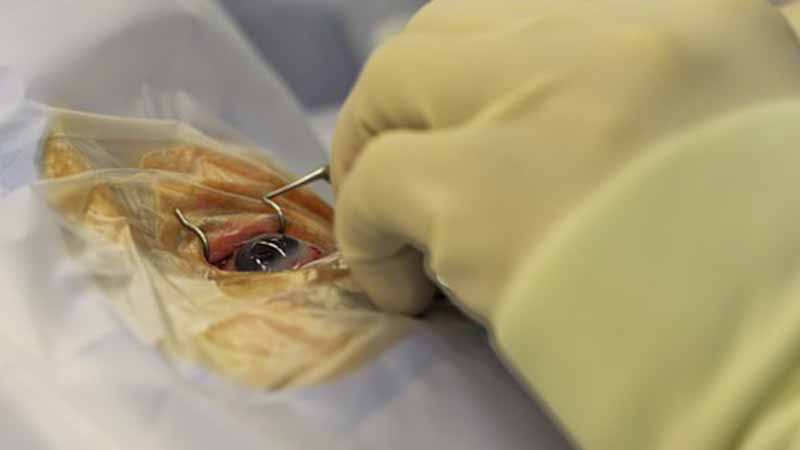 Surgeons find 27 contact lenses inside woman's eye