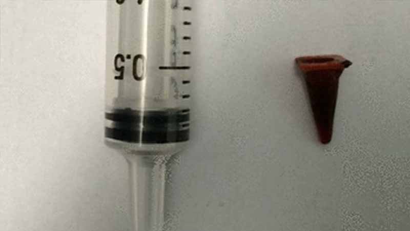 British man's 'lung cancer mass' turns out to be toy traffic cone