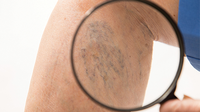 Why varicose veins are dangerous to your health