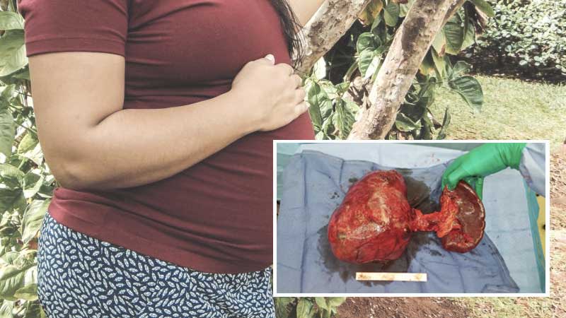 Abu Dhabi doctors remove 3.5kg deadly tumour from woman