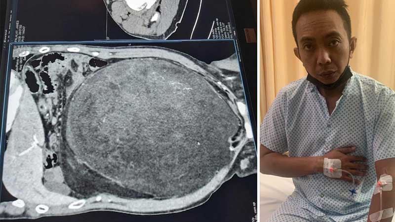 Filipino expat beats death after 7.8kg tumour surgery in Abu Dhabi