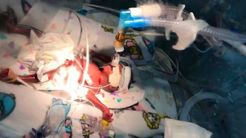 Tiny baby the size of a hand born in Abu Dhabi