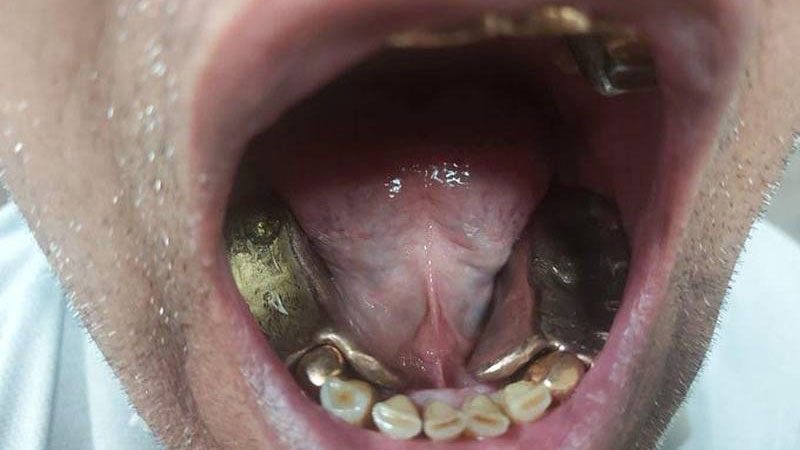 Gold worth Dh20,200 seized from Dubai passenger’s mouth