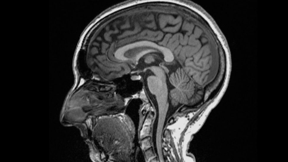 Covid may cause changes to the brain, study reveals