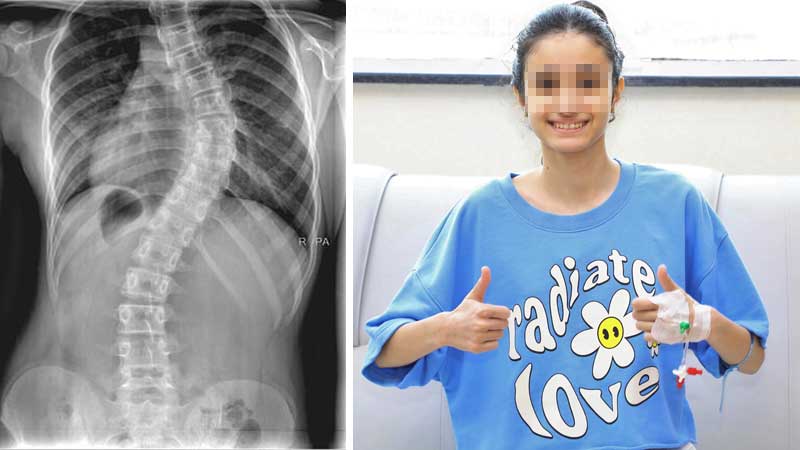 First-of-its-kind surgery in Dubai helps girl with curved spine stand straight