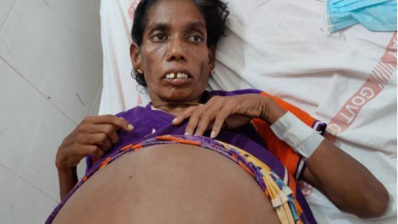 India: 35kg ovarian tumor removed from a mother of three
