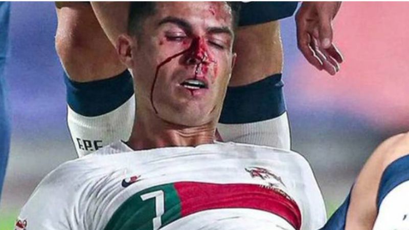 Ronaldo Suffers Severe Facial Injuries in Portugal-Czech Football Match