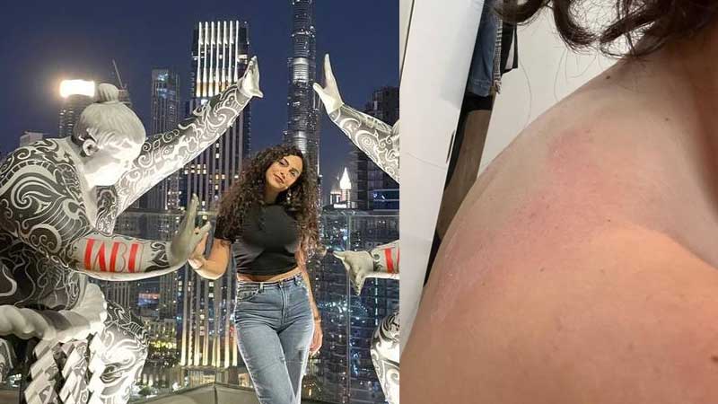 Dubai visitor suffers burns after waiter drops liquid nitrogen on her