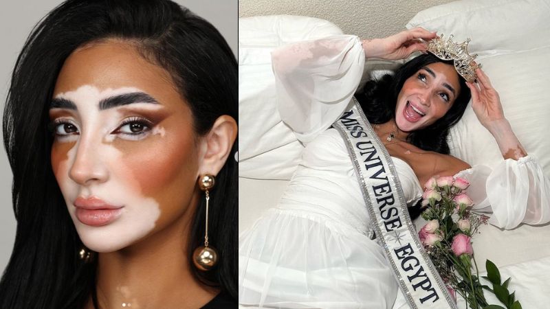 Dubai resident with vitiligo crowned Miss Universe Egypt 2024