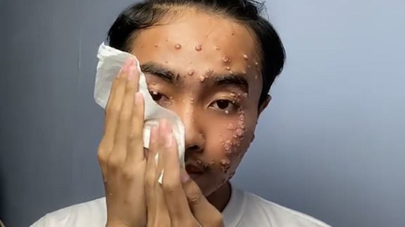 TikToker contracts skin infection from unwashed pre-owned clothes