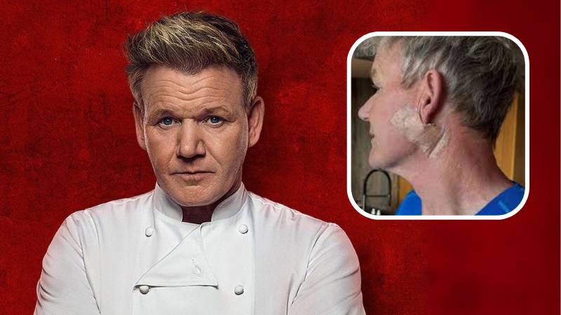 Gordon Ramsay reveals skin cancer diagnosis, urges fans to wear sunscreen